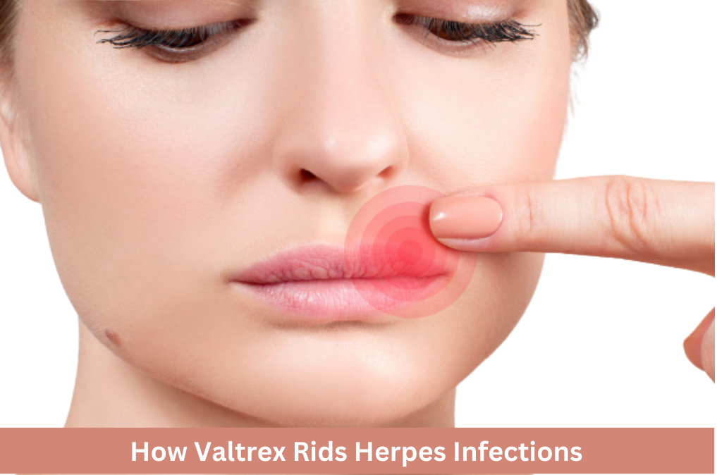 How Valtrex Rids Herpes Infections