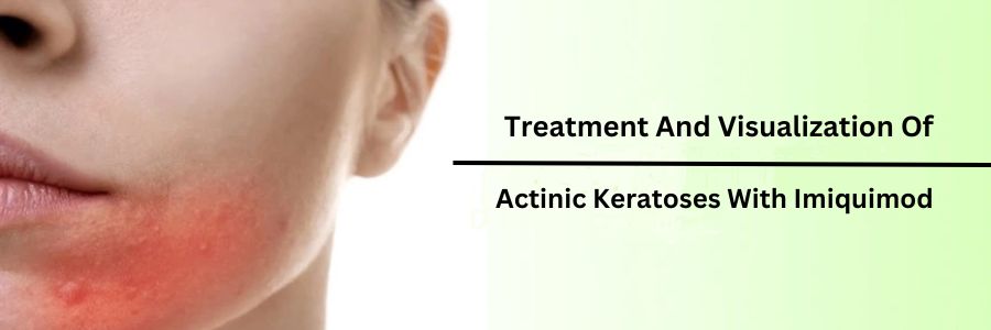 Treatment And Visualization Of Actinic Keratoses With Imiquimod