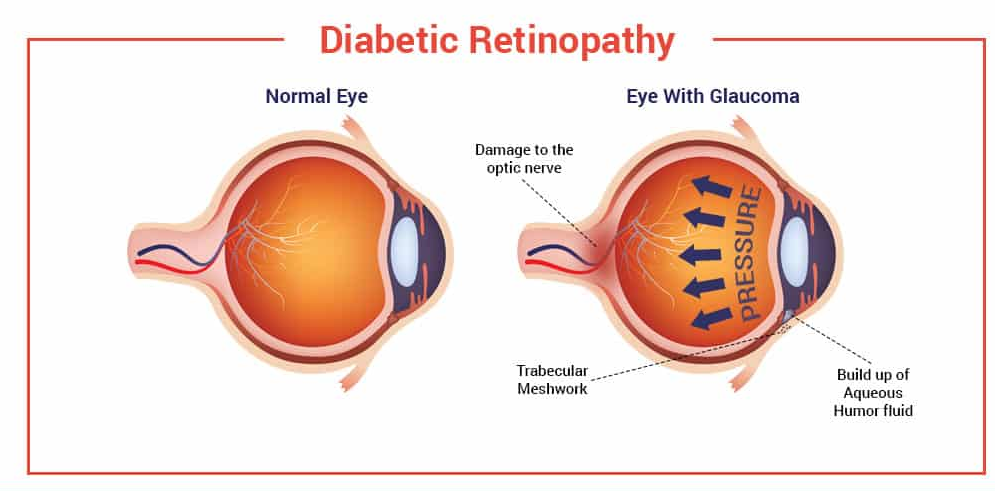 Is glaucoma and diabetes related? Risk, treatment